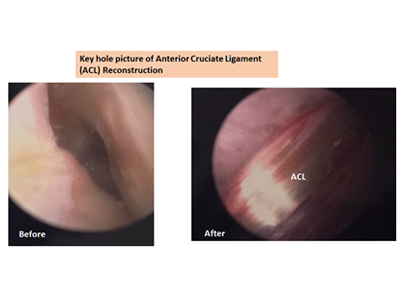 (ACl) Reconstruction